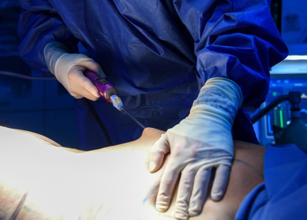 Ameliyathanede liposuction uygulaması — kanülle vücut şekillendirme