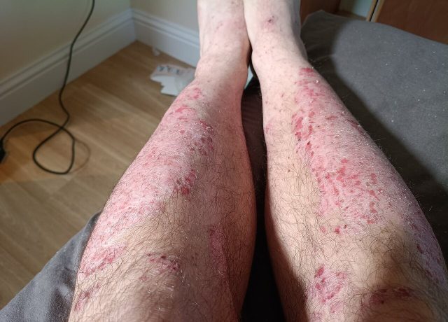 Sedef hastalığı (psoriasis) cilt bulguları — diz ve bacak tutulumu