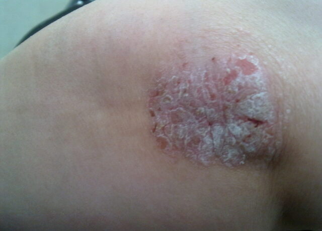 Dirsekte sedef hastalığı (psoriasis) plağı