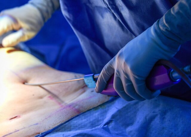 Ameliyathanede karın bölgesine liposuction kanülü uygulayan cerrah